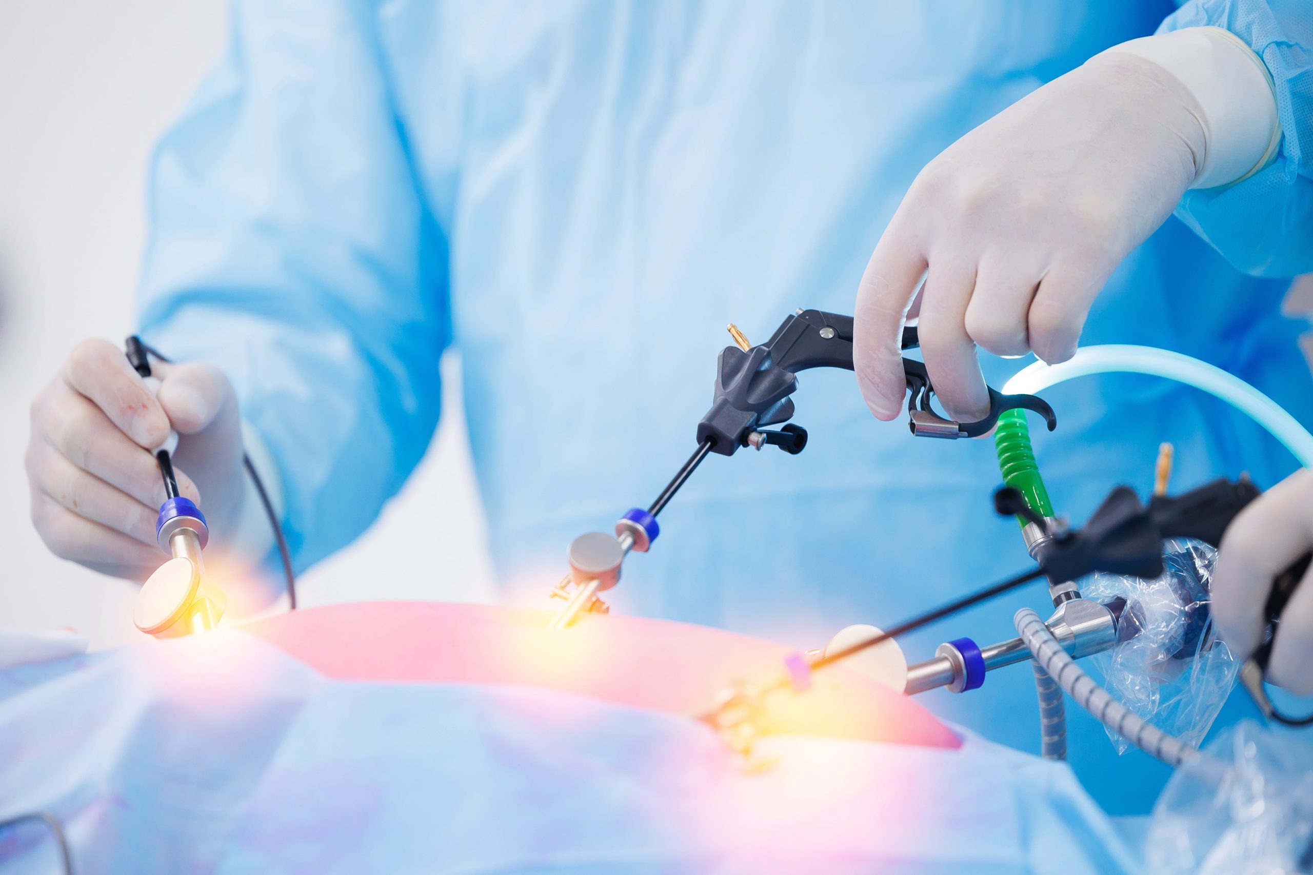 laparoscopic surgery for endometriosis